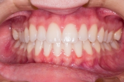 С чего начать лечение зубов?